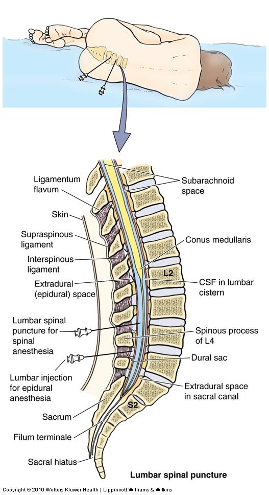 Lumbar Puncture Lumbar puncture is used to withdraw CSF for diagnostic purposes LP performed from lumbar cistern to avoid the damage to the spinal