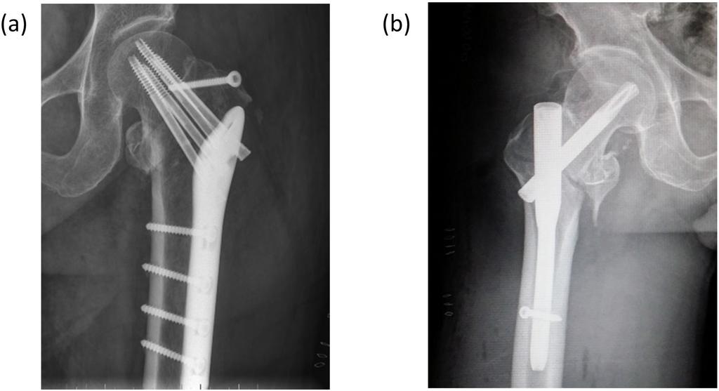 fracture of the lateral wall was closely related with a reoperation after an intertrochanteric fracture and pointed out intertrochanteric fractures should be classified according to the integrity of
