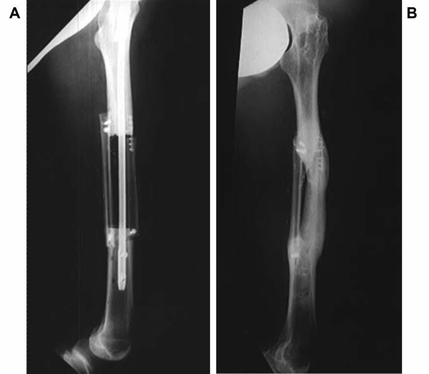 Figure 3. A 23-year-old man presented with a malignant fibrous histiocytoma of the femur shaft. A 12-cm femur defect was reconstructed by 11+15 cm folded free vascularized fibula graft (A).