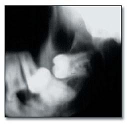 Removal of the osseous mass required aggressive use of bone