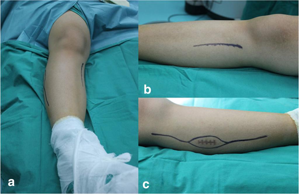 Wan et al. World Journal of Surgical Oncology (2018) 16:65 Page 3 of 6 Fig. 2 a Gross view of the double approach in a patient s leg. b Gross view of the medial approach.