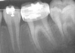 Progress photos & x-rays at 2 months 16 days shows no distal tipping of lower first molars & no mesial movement of lower first molar roots.