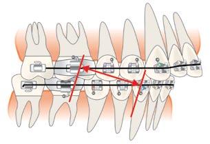 Description of the appliance: Twin Force Bite Corrector (TFBC) Double-Lock Twin Force BiteCorrector Double-Lock is an intraoral and intermaxillary appliance and it is used in Class II malocclusion