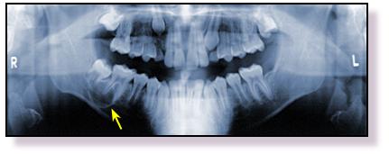 Volume 1 Number 2 Winter Issue, 2000 Odontogenic Keratocyst: The Northwestern USA Experience Abstract Odontogenic keratocyst (OKC) is a cyst of tooth origin with an aggressive clinical behavior