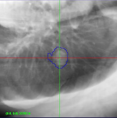 Lung tumor tracking