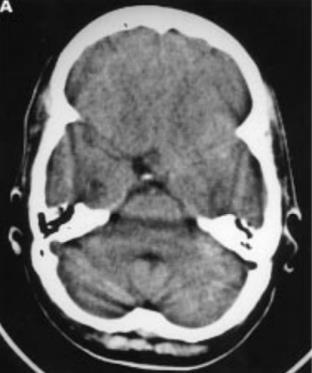 Is MRI useful in the diagnosis of SAH?