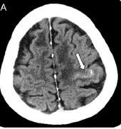 Cerebral Amyloid Angiopathy Case series of 38 patients with histopathological proven CAA were reviewed.