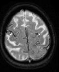 Focal SAH on CT that can be seen with CAA Neurology 2010; 74(17): 1346-50 Findings: CAA patients: 60.