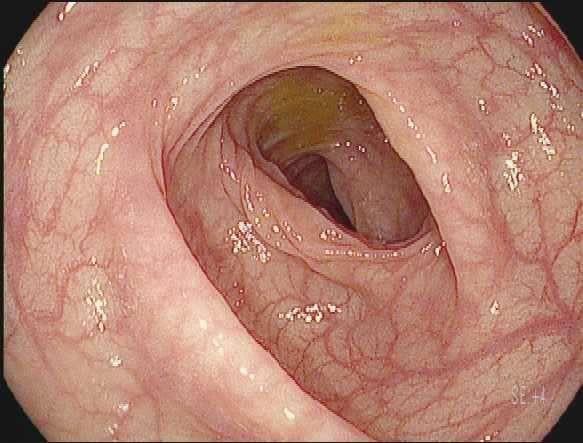 Endoscopic Appearance Coli:s Normal