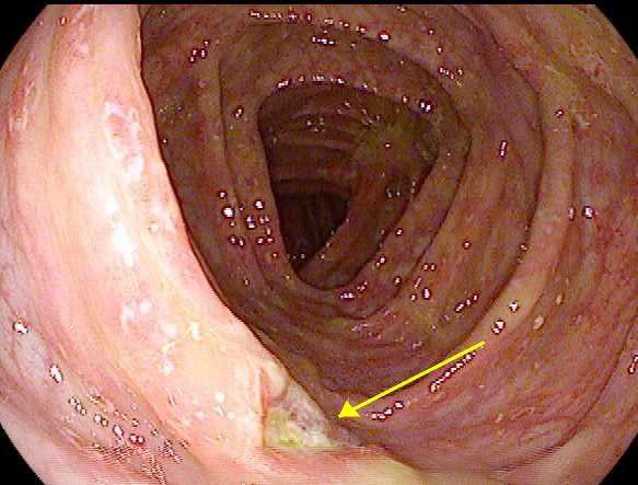 Crohns type disease does occur Nivolumab (13