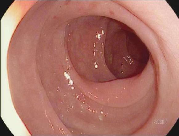 Microscopic colitis Can be high grade based on diarrhea criteria Responds to budesonide Does not require