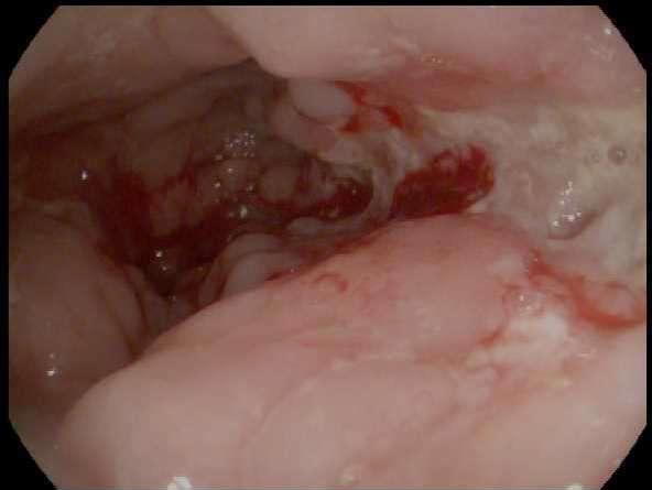 How similar is checkpoint colitis to
