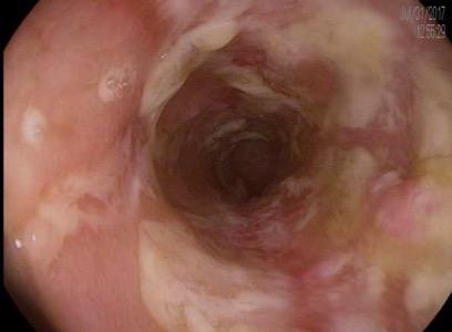 Checkpoint Colitis Typically a pan