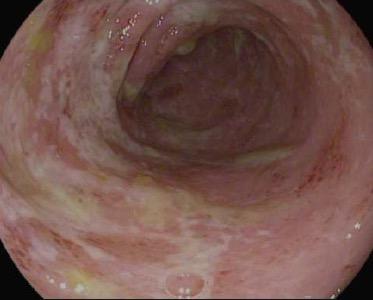 ulcers and strictures are rare Fistulas