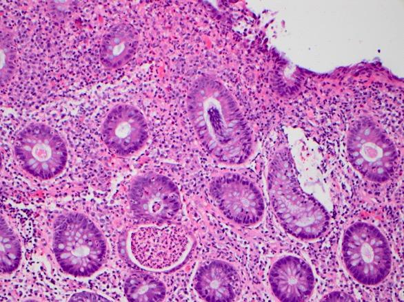 Histology of Typical Checkpoint Colitis Lymphocytic and neutrophilic infiltrate Prominent