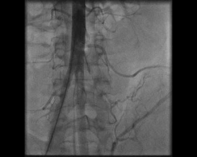 Angiography and interventional coiling of the