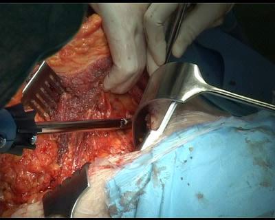 Surgery team s approach - vascular and orthopaedics Vascular surgeon performed vascular preservation of the operative field The tumor was eradicated by combination of enblock resection and