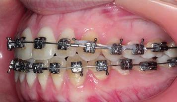 bonded directly to the lower canines and first molars with