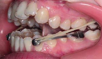 moderate Class III malocclusion with negative overjet,