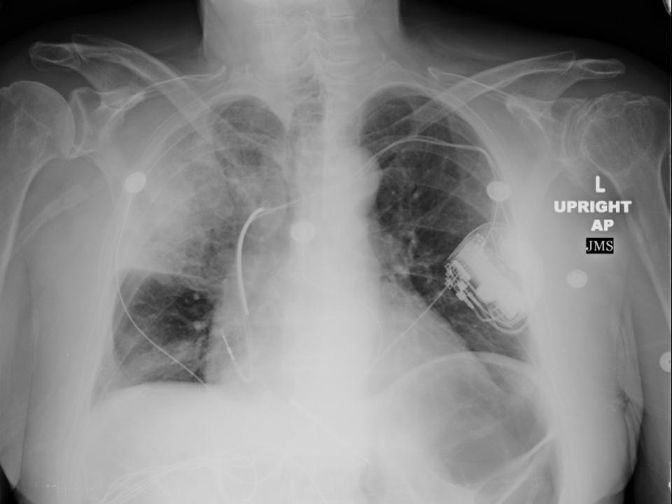 Figure 1. Admission radiograph demonstrating right upper lobe airspace disease.