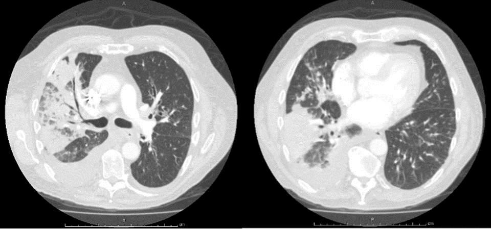 coccidioidomycosis. A CT angiogram of the chest showed bilateral multilobar pneumonia (Figure 2). Figure 2. CT angiogram of the chest demonstrating multilobar consolidation of the right lung.