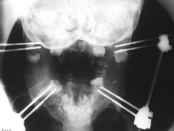 PARASHAR et al Figure 5. Plain X-ray of the mandible showing distracted mandible in Case 1 at the age of 3 years and 2 months. tistry, speech pathology and physiotherapy.