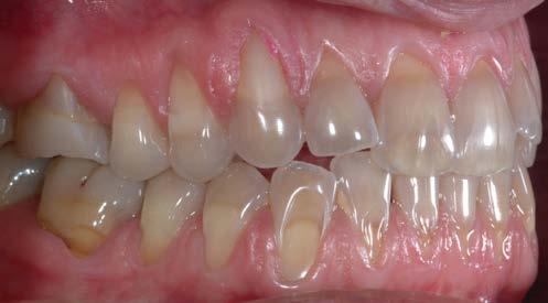 Figure 5 b-d Composite restorations of both upper and lower arches aimed to protect tissues and