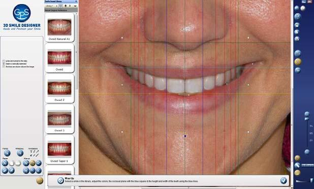 The practitioner uses the virtual 2D wax-up in the diagnostic process to determine the treatment options appropriate for this patient, such as orthodontics, crowns, implants, and bridges, full or