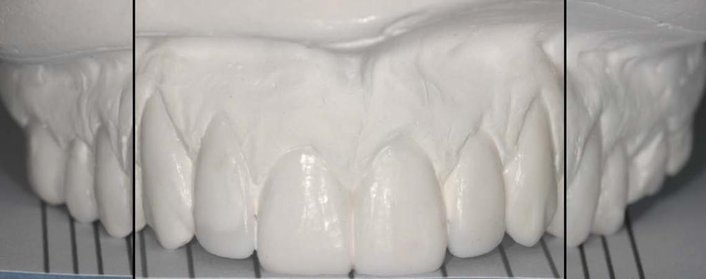 Figure 11 b Printed Y-axis of the M Ruler guides the technician to create a very precise wax-up of the future smile.