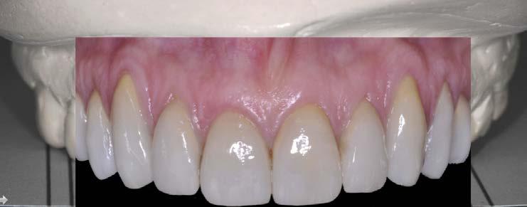respect the pre-programmed esthetic. Personalization of final ceramics is possible.