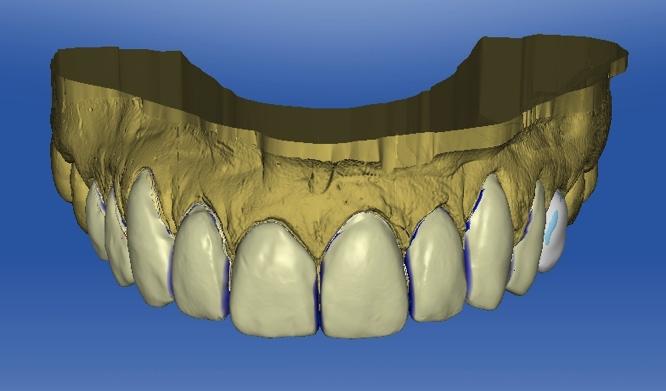 controlling ceramic thickness and maintaining structural integrity of the tooth.