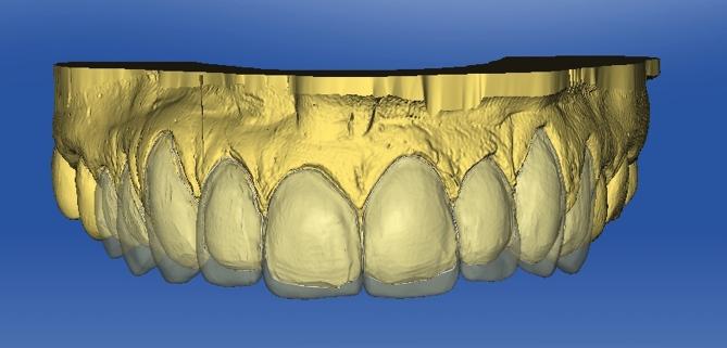 Cerec system (Sirona) to project (Figure 12 a,b,c) and produce chairside 9 upper and 10 lower veneers using Empress CAD