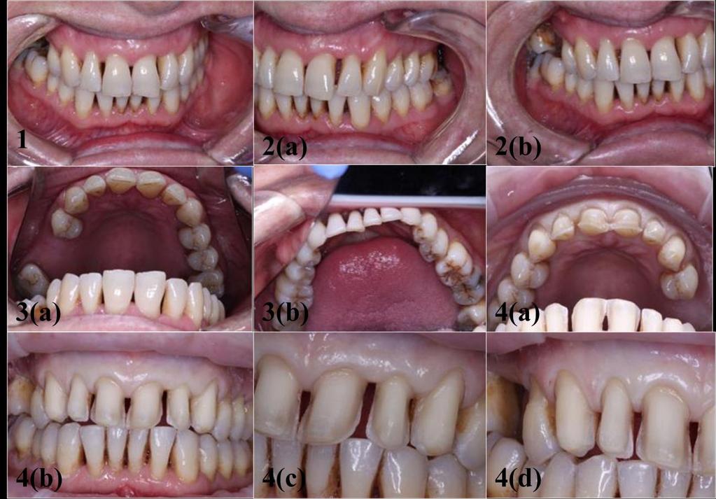 Figures: (1) Pre-operative photograph of the teeth-frontal view; 2(a) Baseline front view and detailed view of the left anterior maxillary teeth; 2(b) Baseline front view and detailed view of the