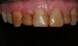insufficient tooth structure ) All Ceramic Restorations Litium-disilicate A. pressed B.