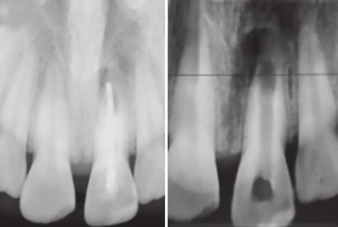 The root canal of 21 was then obturated using customized guttapercha and Endoseal MT sealer (ENDOCEM, Maruchi Products). fter completion of root canal treatment, the surgical procedure ensued.