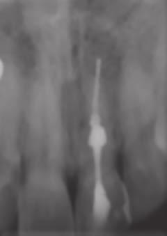 On probing, the periodontal probing depth on the labial aspect of 21 was 7 mm with extrusion of gutta-percha through the gingival sulcus.