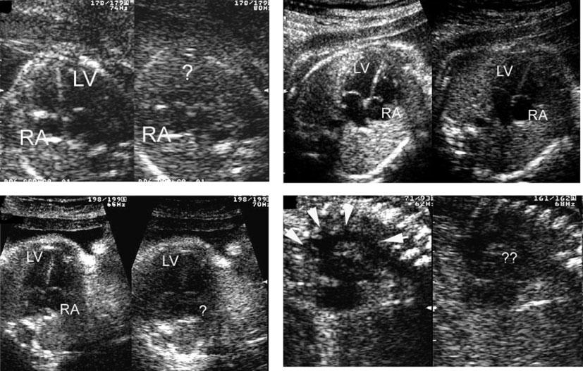 Harmonic imaging in fetal echocardiography 161 significant. Confidence limits were calculated for all variables. (P < 0.001 and P < 0.01, respectively; Table 3).