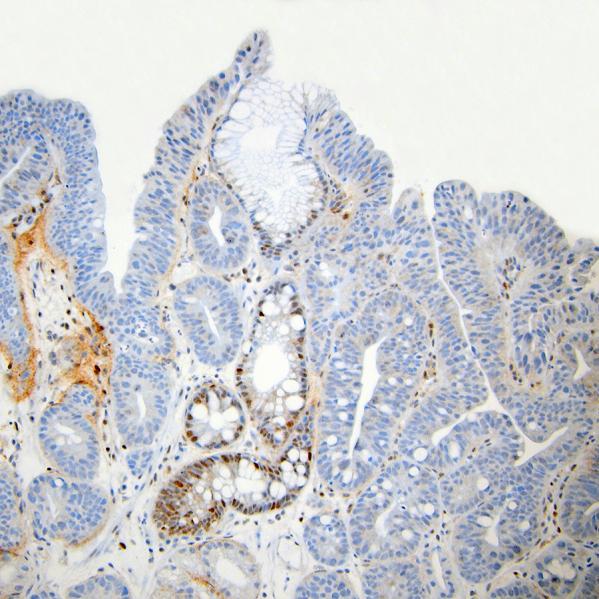 Strong and diffuse p53 staining correlates with TP53 mutations