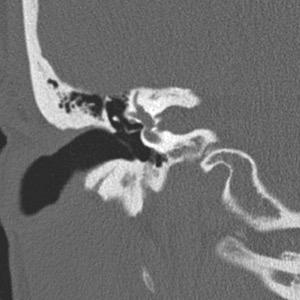 Middle ear-mastoid Temporal (CPA/IAC) MRI Membranous labyrinth Internal auditory canal ICA & venous segments Anatomic Approach Results from