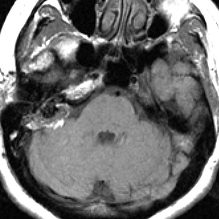 Intracochlear, Adult Common Vestibular Meningioma Epidermoid Aneurysm T-bone fracture