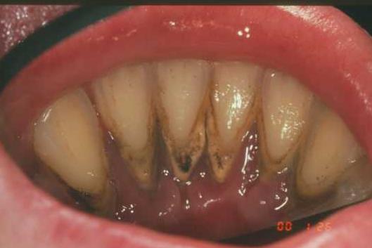 First instruation and motivation Elimination of etiological factors Dentist, dental hygenist Biofilm, dental plaque - causal relationship with dental biofilms, a positive