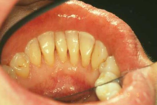 Maintenance therapy In periodontal maintenance patients, mechanical debridement reduces inflammation and disturbs the