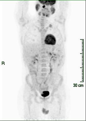 Day 190 R-CHOP initiated. Day 245 Interim PET-CT (after R-CHOP x 3): Resolution of abdominal lymphadenopathy Localized 1.