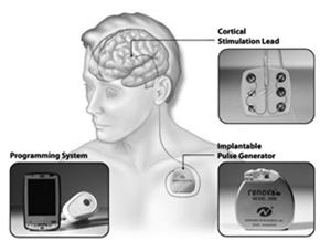 Clin Rehabil, 2014 Implanted cortical stimulation Theta-burst stimulation Phase 1: Adams RCT, non-blinded, multicenter study of safety and secondarily of efficacy of subthreshold cortical stimulation