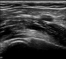 Anterior Longitudinal (Medial Probe Angle = tendon ) 1 3 2 Lateral Approach attachment