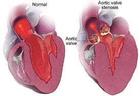 Aortic Stenosis Aortic Stenosis: Goals What is the valve area? Does the patient have syncope, chest pain, or pulmonary edema?