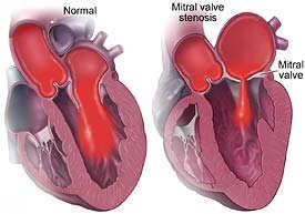 Mitral Stenosis Mitral stenosis goals Percutaneous mitral valvuloplasty can be considered during pregnancy for unstable mother.