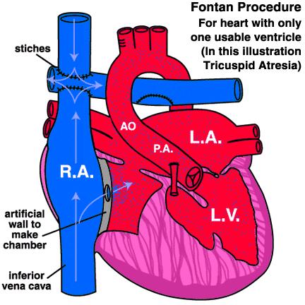 Single Ventricle-Fontan Physiology Single ventricle is made into the pumping chamber. All blood flow to lung is passive flow through right atrium and some times artificial chamber.