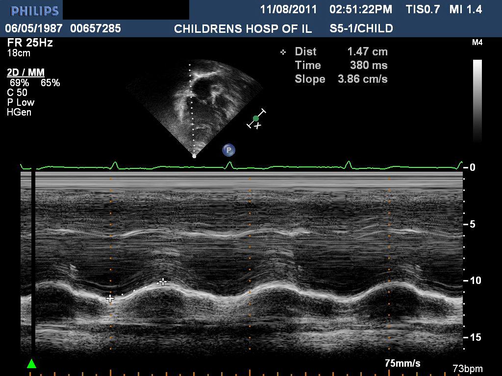 2-2D trace of RV endocardial border at peak systole and end diastole to figure fractional area change (FAC) (see figure 3 ) 3-M-mode