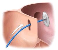Clinical Therapy Surgical ligation of PDA. Intravenous indomethacin often stimulate the closure of the ductus atreriosus.